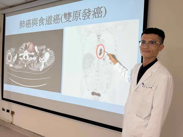菸酒不離身 68歲台商驚罹雙原發癌1