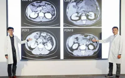 輕忽小小膽結石 引發急性壞死性胰臟炎