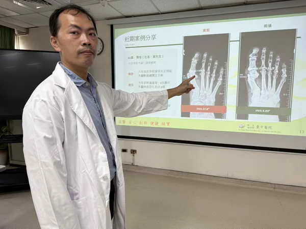 登山男兩度拇指外翻 截骨矯正術治癒1