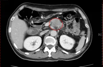 長期罹糖尿病 胰臟癌風險增加二倍