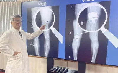 中榮機械手臂置換 舞蹈老師換膝重返舞台