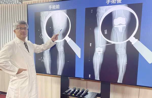 中榮機械手臂置換 舞蹈老師換膝重返舞台1