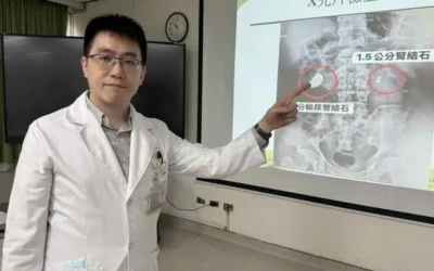 男腰痠血尿就醫 輸尿管赫見大結石