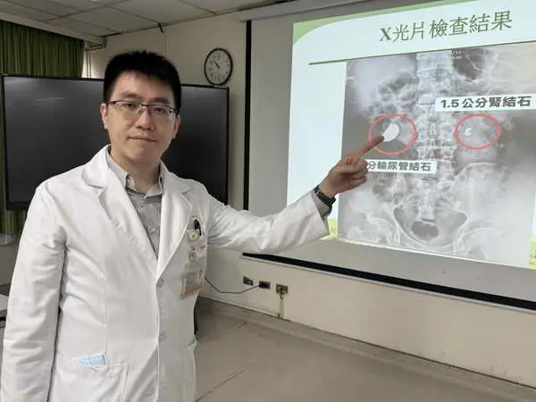 男腰痠血尿就醫 輸尿管赫見大結石1