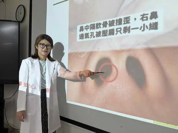 蘋果姐姐鼻子撞歪 鼻整形術回復堅挺1