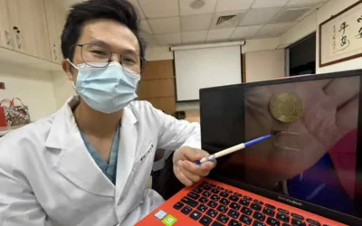 男胸痛半天掛急診竟是魚刺卡食道