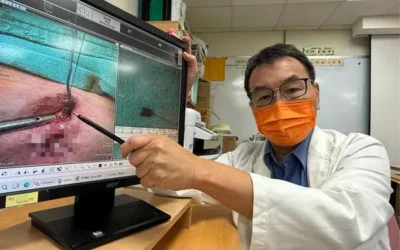 手術切除「肛門廔管」告別濕褲困擾