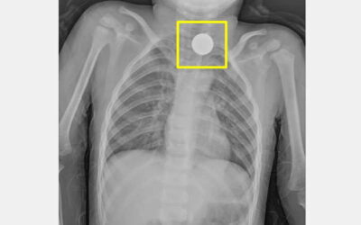 3歲幼童吞入硬幣 仁愛醫師聯手解除危機