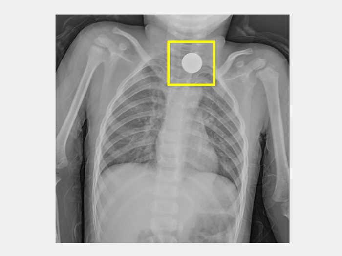 3歲幼童吞入硬幣 仁愛醫師聯手解除危機1