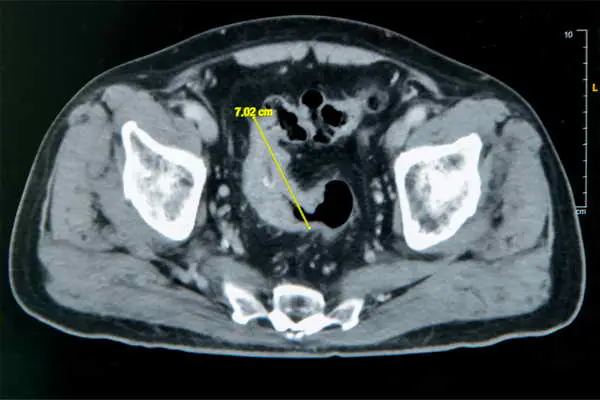 雲林七旬翁便秘竟是7 公分大腸癌1