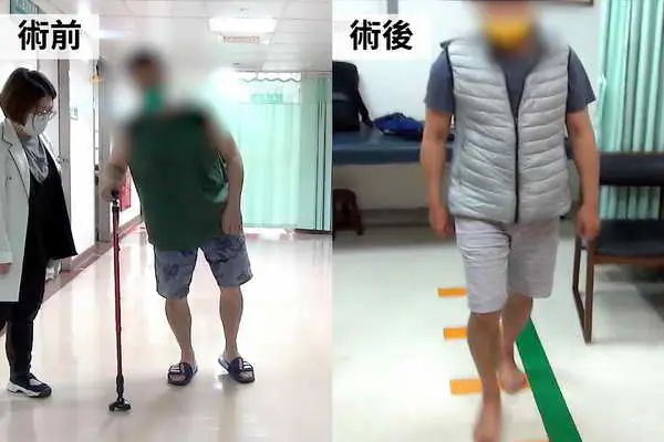 清醒手術助攻 彰基成功執行精準帕金森氏症DBS療法1