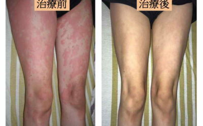 全身皮疹大發作 原來是甲狀腺有問題
