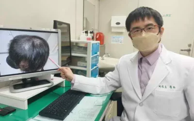 疑似雄性禿 掉髮禍首竟是二期梅毒