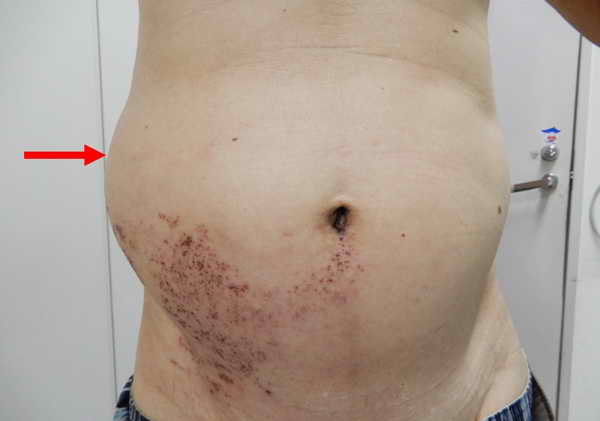 皮蛇纏腰 右腰驚見鼓脹一大塊 帶狀疱疹併發症 病毒影響運動神經致腹壁肌肉鬆弛1