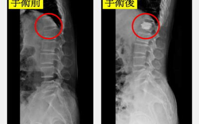 老婦彎腰骨折劇痛 微創低溫骨水泥灌注治癒