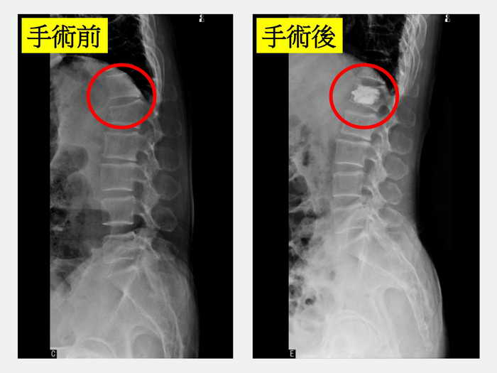 老婦彎腰骨折劇痛 微創低溫骨水泥灌注治癒1