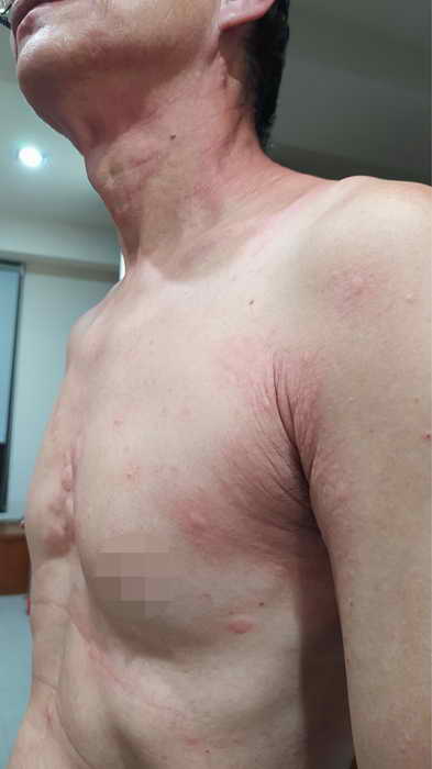 過敏成因多潛藏致命危機 體質特殊者莫輕忽1